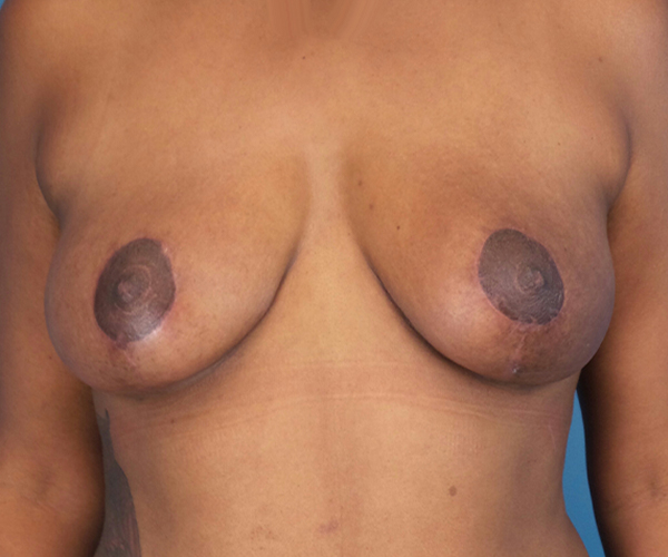 after breast lift front view case 871