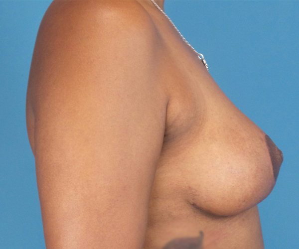 after breast lift side view case 871