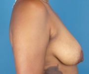 before breast lift side view case 871