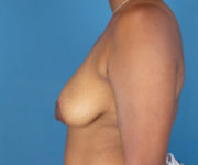 before breast lift side view case 871