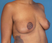 after breast lift 45 view case 871