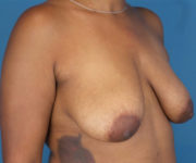 before breast lift 45 view case 871