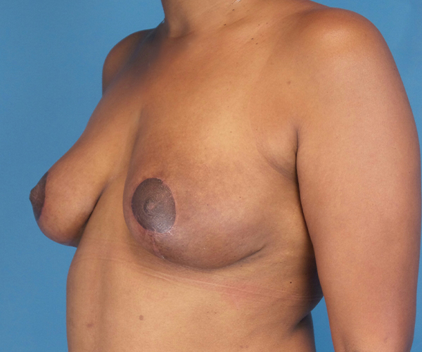after breast lift 45 view case 871