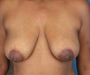 before breast lift front view case 871
