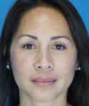 After Eyelid Lift Female Patient Front Angle View Case 860