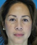Before Eyelid Lift Female Patient Front Angle View Case 860