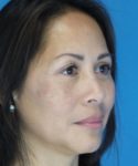 After Eyelid Lift Female Patient Right Angle View Case 860
