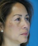 Before Eyelid Lift Female Patient Right Angle View Case 860