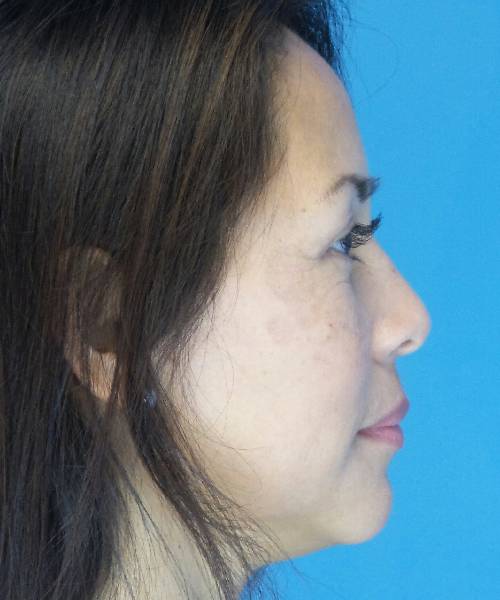 After Eyelid Lift Female Patient Right Side Angle View Case 860