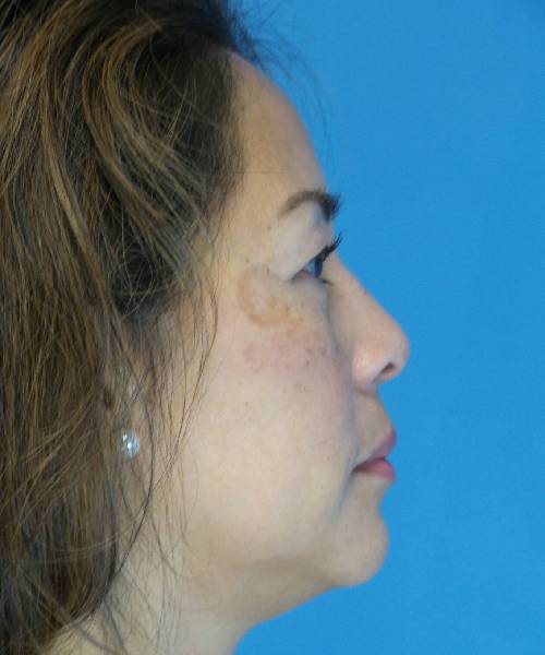 Before Eyelid Lift Female Patient Right Side Angle View Case 860