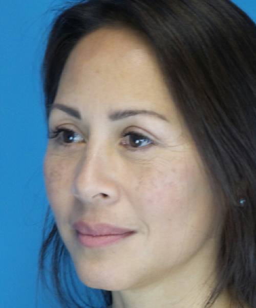 After Eyelid Lift Female Patient Left Angle View Case 860