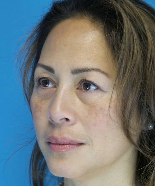 Before Eyelid Lift Female Patient Left Angle View Case 860