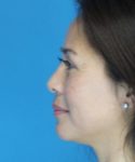 After Eyelid Lift Female Patient Left Side Angle View Case 860