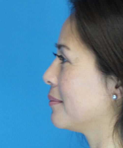 After Eyelid Lift Female Patient Left Side Angle View Case 860