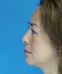 Before Eyelid Lift Female Patient Left Side Angle View Case 860