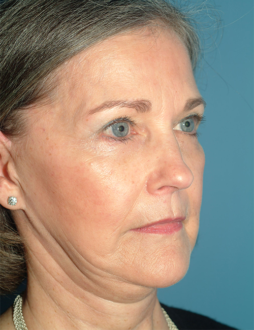 before facelift 45 view case 830