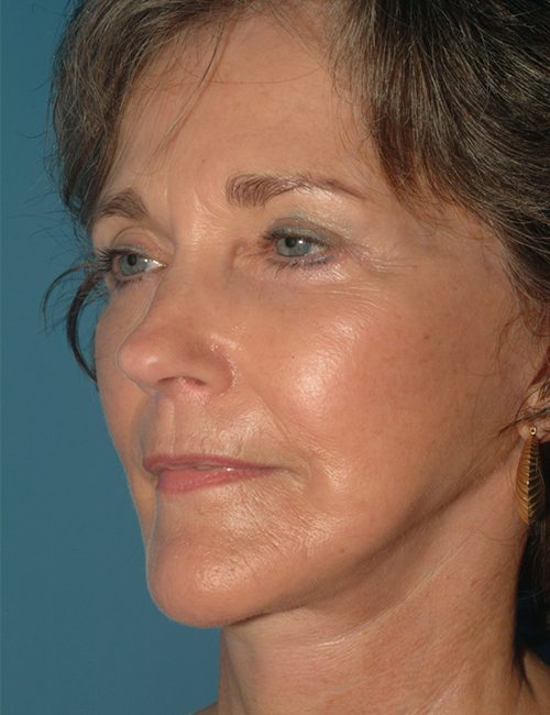after facelift 45 view case 830