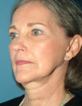 before facelift 45 view case 830