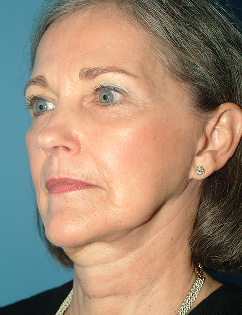 before facelift 45 view case 830