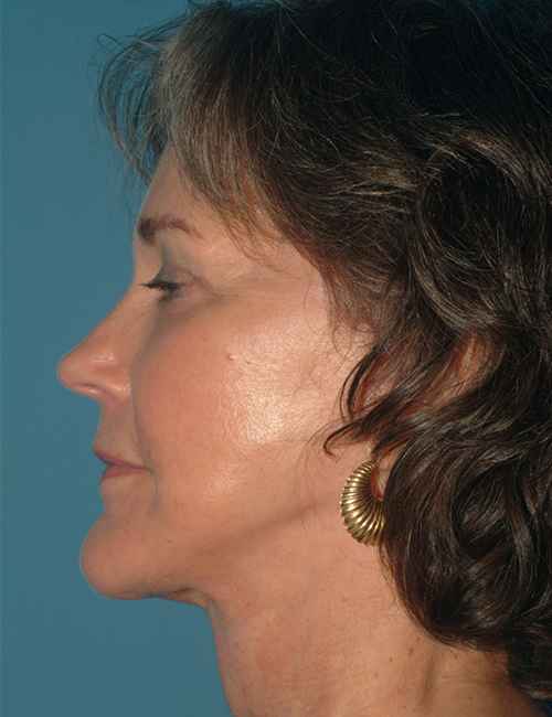 after facelift side view case 830
