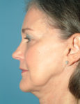 before facelift side view case 830