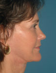 after facelift side view case 830