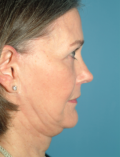 before facelift side view case 830