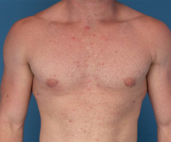 after gynecomastia front view case 885