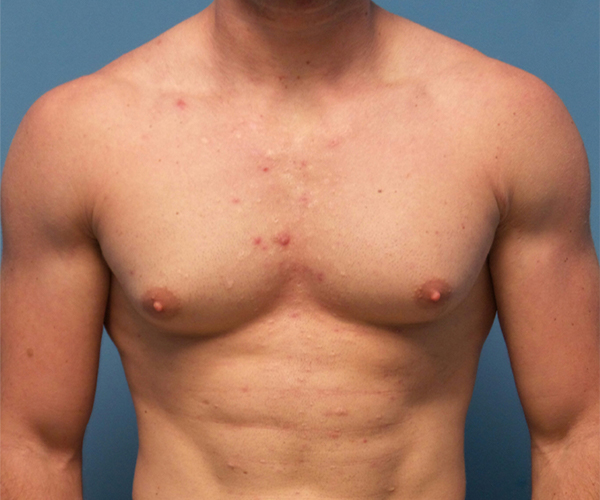 before gynecomastia front view case 885