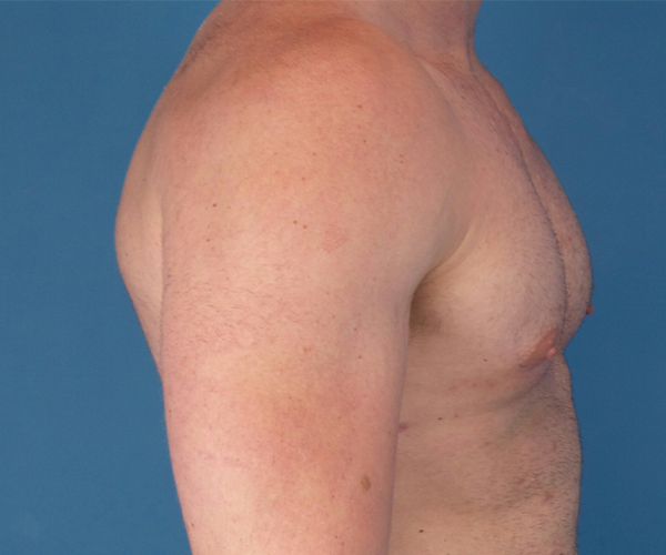 after gynecomastia side view case 885