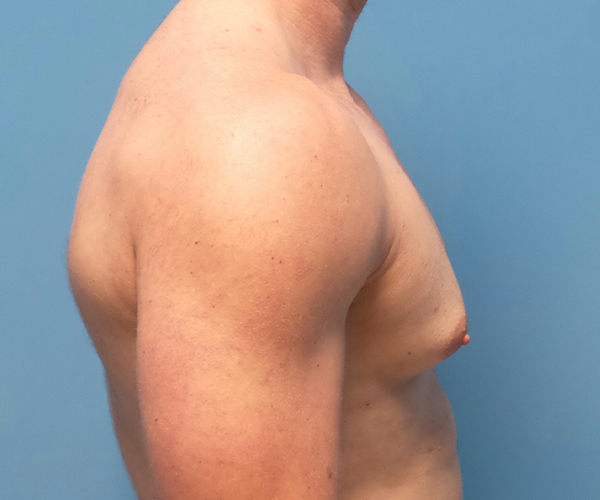 before gynecomastia side view case 885