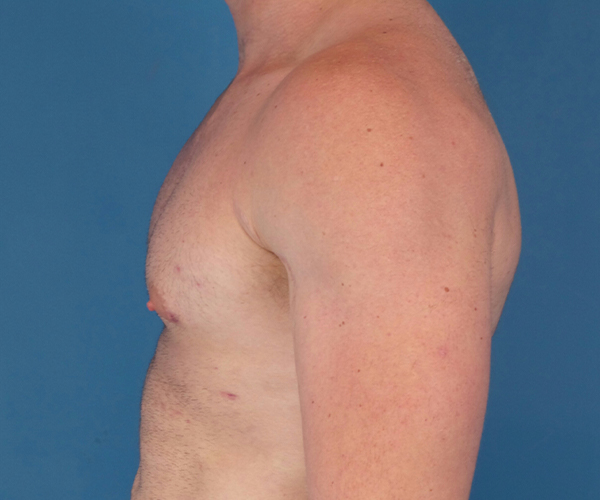 after gynecomastia side view case 885