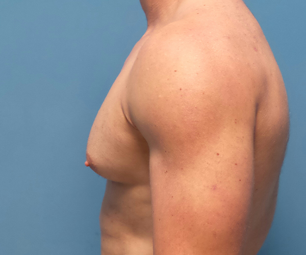before gynecomastia side view case 885