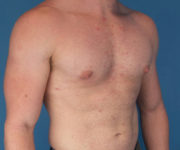 after gynecomastia 45 view case 885