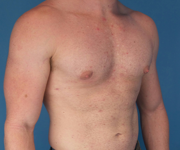 after gynecomastia 45 view case 885