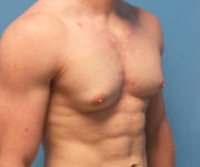 before gynecomastia 45 view case 885