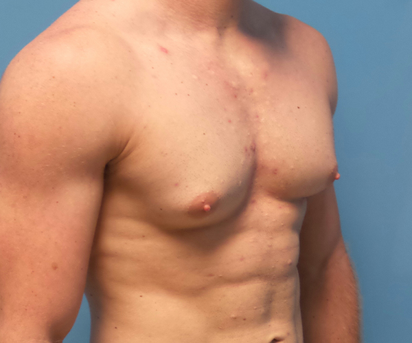 before gynecomastia 45 view case 885