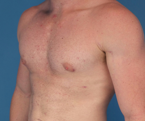 after gynecomastia 45 view case 885