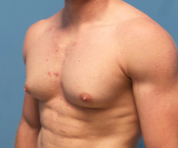before gynecomastia 45 view case 885
