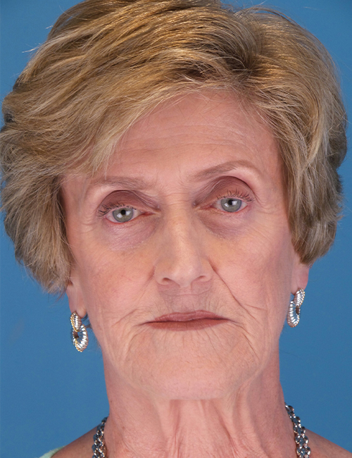 after laser skin resurfacing front view case 853