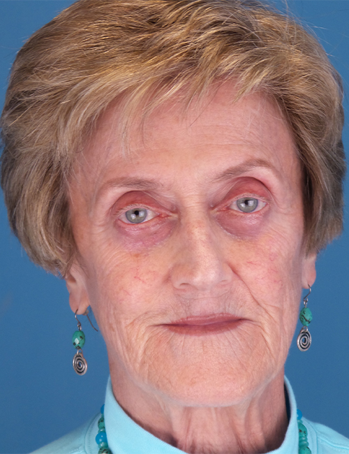 before laser skin resurfacing front view case 853
