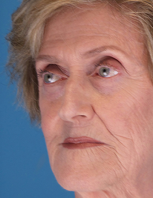 after laser skin resurfacing 45 view case 853