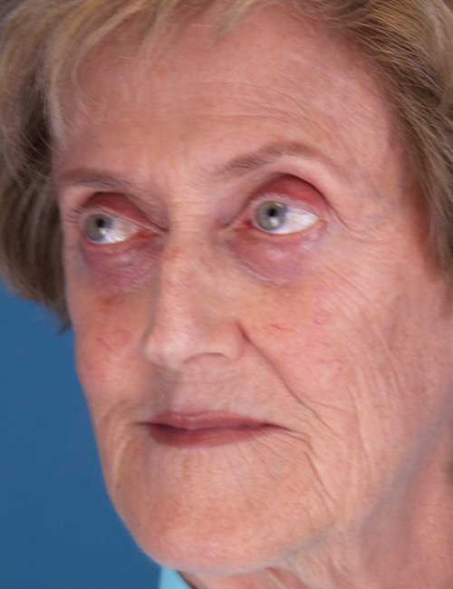 before laser skin resurfacing 45 view case 853