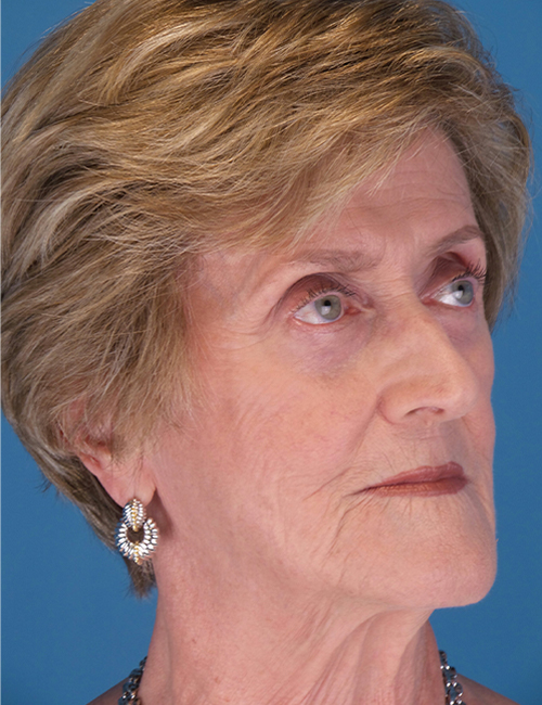 after laser skin resurfacing 45 view case 853