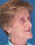 before laser skin resurfacing 45 view case 853