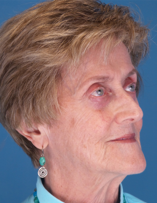 before laser skin resurfacing 45 view case 853