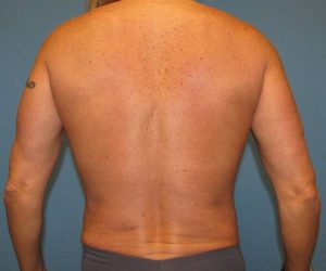 After Liposuction Male Patient Back Angle View Case 882