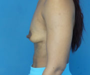 before breast augmentation left side view case 2187
