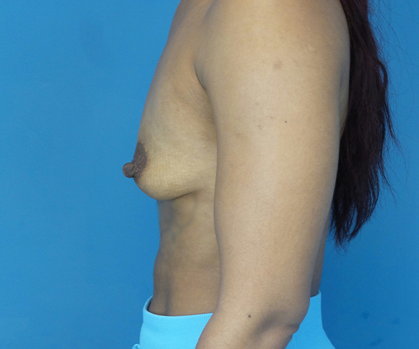before breast augmentation left side view case 2187