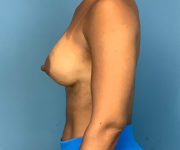 after breast augmentation left side view case 2187